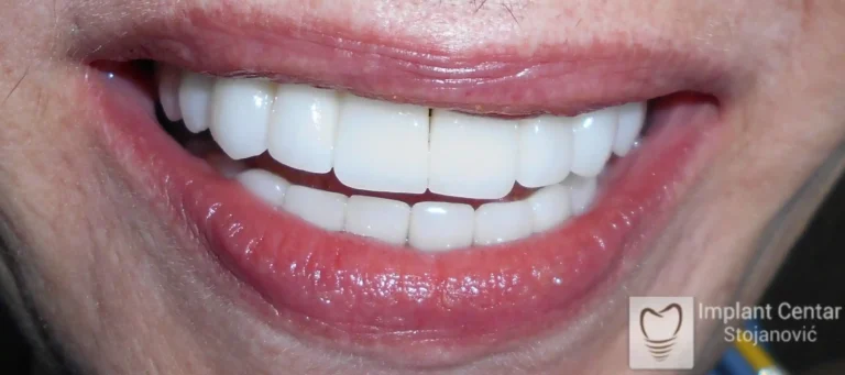 Slika 6. Klinički izgled pacijenta nakoncementiranja definitivnog protetsko rada.