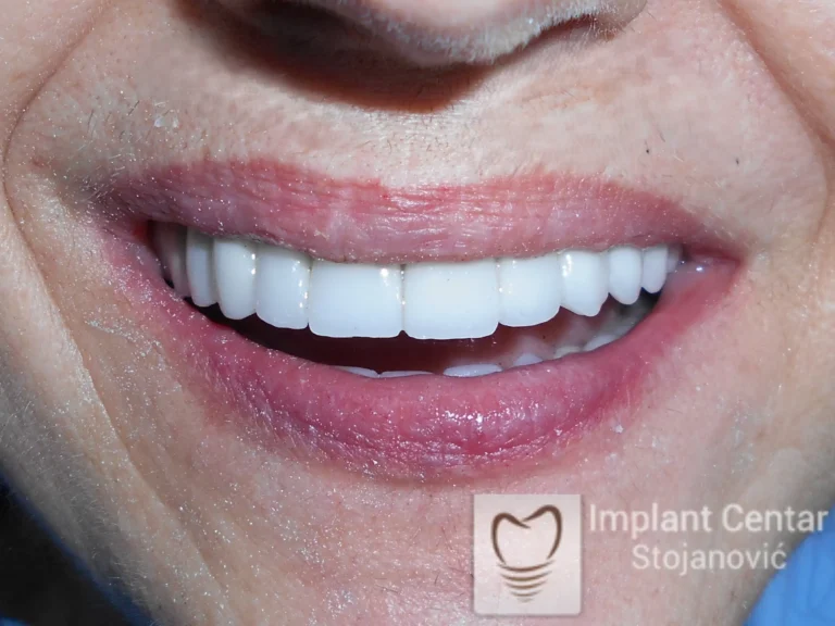 Klinički izgled pacijenta nakon cemetiranja definitivnog protetskog rada