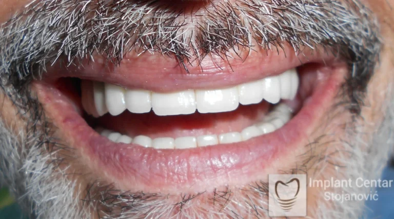 Slika 8. Klinički izgle pacijenta nakon cementiranja definitivnog protetskog rada