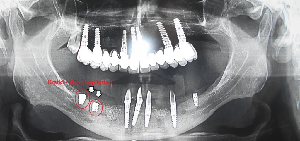 Primena kratkih implantata