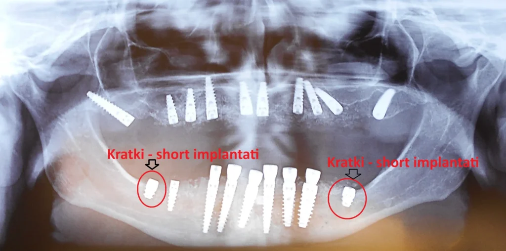 Kratki implantati u praksi