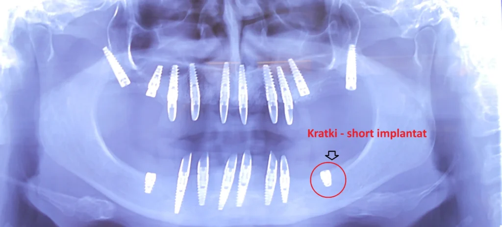 Kratki implantati – primer