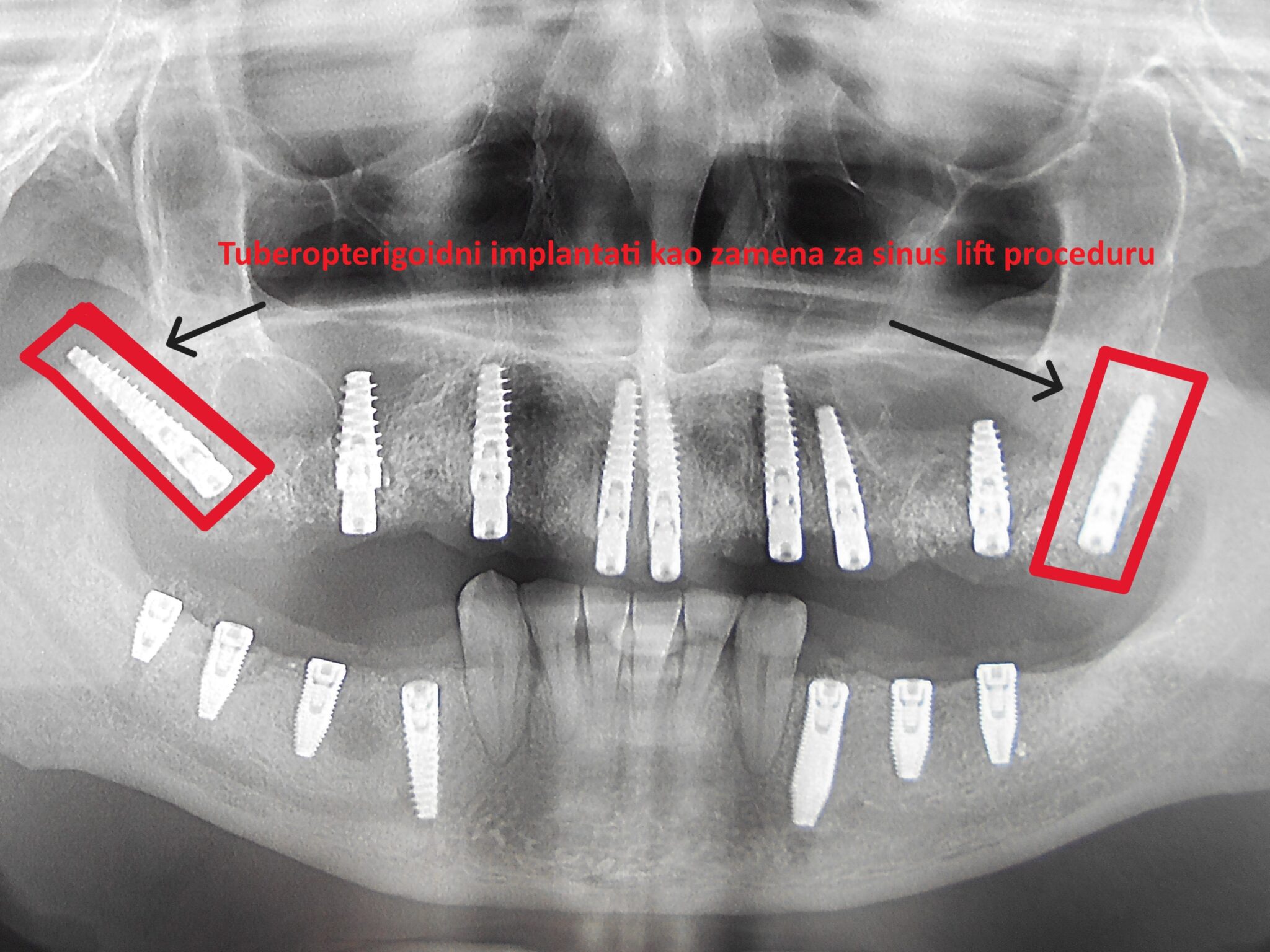 Tuber-pterigoidni implantati - slučaj
